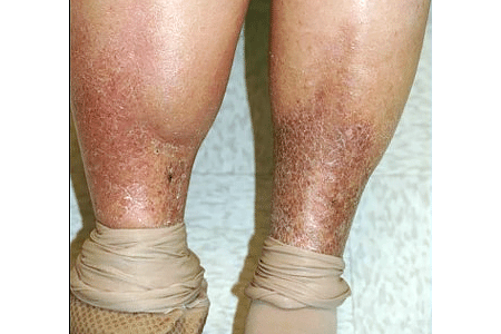 leg changes stasis dermatitis