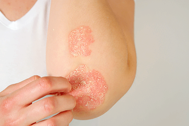 Close up of female patient suffering from psoriasis skin disease on elbow