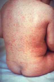 Figure 2. This image depicts a child’s torso, revealing coalescent morbilliform papules due to a case of rubella. Source: CDC. (4)