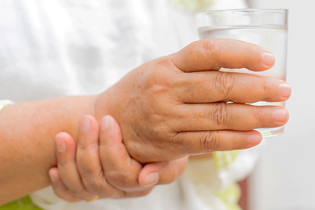 Woman with Parkinson’s disease and worsening hyperhidrosis