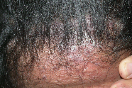 Hair loss due to acne keloidalis nuchae