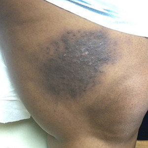 Cutaneous signs of IgG4-related skin disease on a woman's leg | American Academy of Dermatology (AAD).