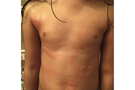 Hives caused by COVID-19.
