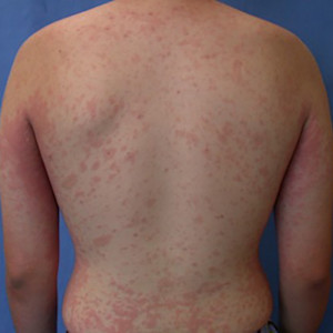 Pityriasis rosea or a pityriasis rosea-like eruption | American Academy of Dermatology (AAD).