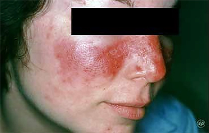 Butterfly rash of lupus