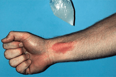 The red welt on this man’s wrist is a hive caused by cold.