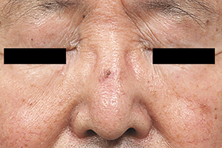 The spot on this man’s nose is an actinic keratosis