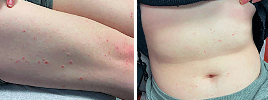 Public>Diseases>A-Z>Lichen planus>Overview>Small bumps