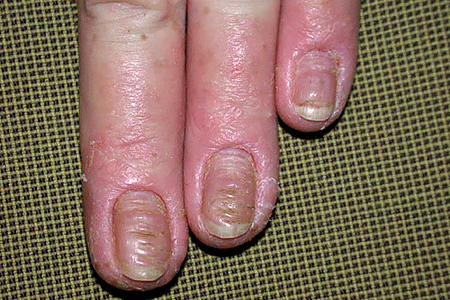 Thick, discolored nails