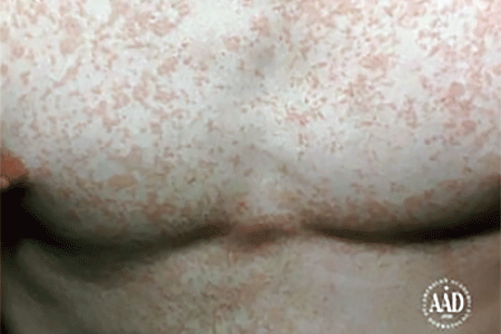 Tinea versicolor on a man's chest