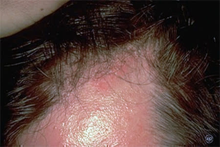 Reddish, oily-looking patches on the face and scalp