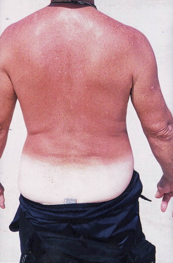 DWII illustration of sunburn