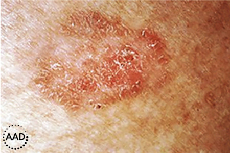 A reddish, brown scaly patch is a type of skin cancer called squamous cell carcinoma | American Academy of Dermatology (AAD).