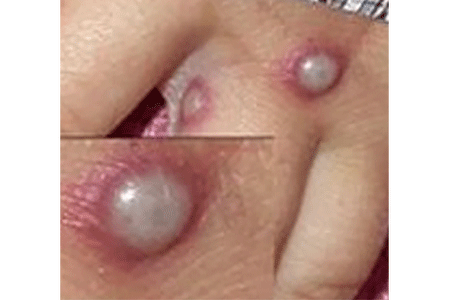 Monkeypox rash on patient’s hand