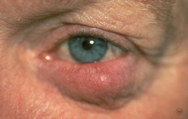 acne rosacea eyes