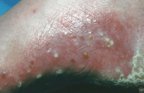 infected psoriasis