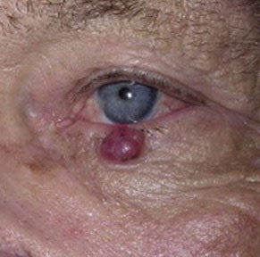 A Merkel cell carcinoma growing below the eye of a man | American Academy of Dermatology (AAD).