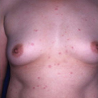 A woman's chest showing signs of atrophic papulosis.