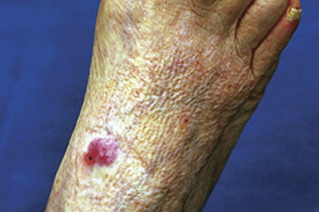 Merkel cell carcinoma on the inner ankle area of patient's foot