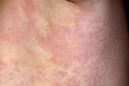 57-Year-Old Female With 2-Day History of Sore Bumps on Trunk
