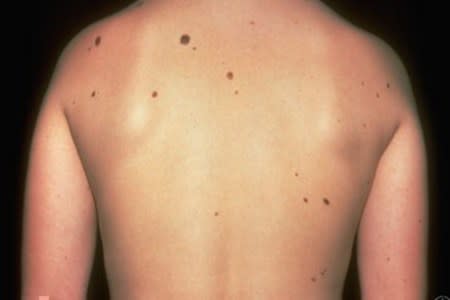 Atypical moles on a patient's back