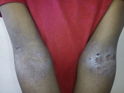 Image of break down in skin barrier for DWII