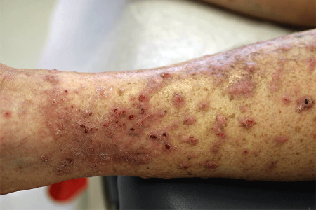 Bumps on skin, some with scabs.
