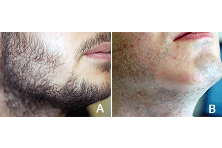 Patchy hair loss on beard due to alopecia areata (A) and a smooth, bald patch on beard caused by alopecia areata (B)
