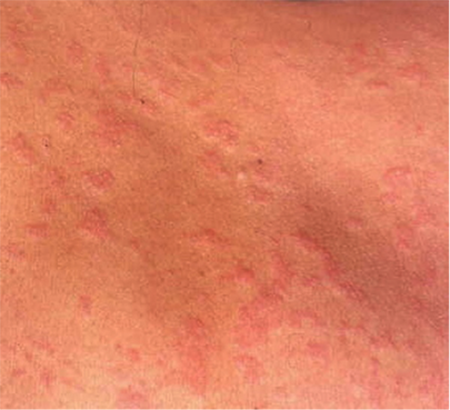 picture of hives