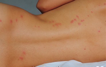 pictures of bed bugs rash