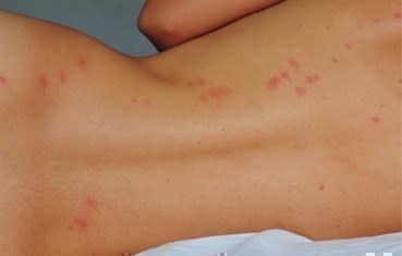 Woman with clusters of bedbug bites on her backside