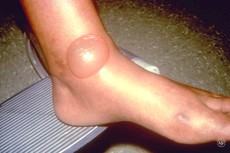 skin blisters causes