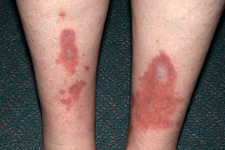 Slowly growing patches of discolored skin called necrobiosis lipoidica on shins of person with diabetes.