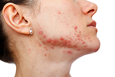 Stubborn acne? Hormonal therapy may help