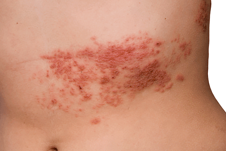 Close-up of the herpes zoster rash, otherwise known as shingles, on a woman's stomach