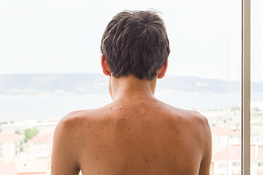 Back acne: How to get rid of it and how to prevent it
