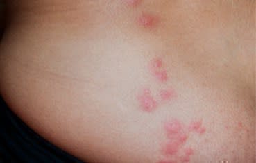 Red welts shown here are bed bug bites