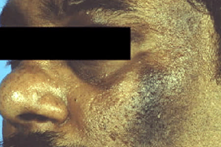 Acanthosis nigricans: Tips for managing