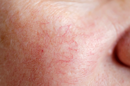 Visible blood vessels due to rosacea