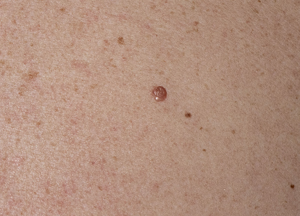 The back of a BAP1 TPDS patient with a BAP1 inactivated melanocytoma. Courtesy Edward Cowen, MD, MHSc, FAAD, NIAMS, NIH. 