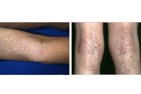 Thickening skin on arm due to atopic dermatitis and thickening skin and rash on back of child’s knees due to atopic dermatitis