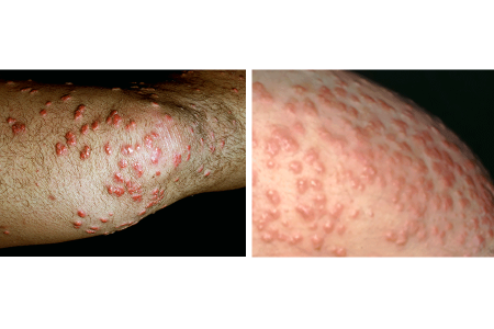 Tender, itchy bumps on knee can be sign of diabetes. Diabetic with bumps on skin called eruptive xanthomatosis
