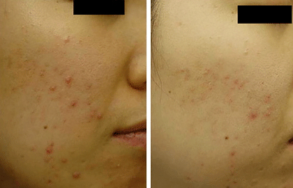 Before and after man with acne laser treatment