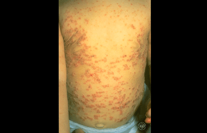 Child with guttate psoriasis