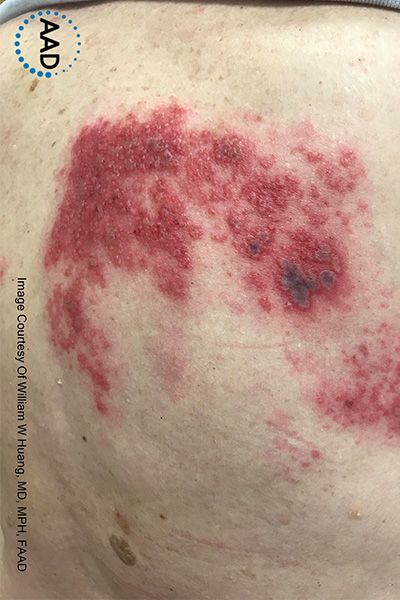 Varicella-zoster figure 6. Grouped hemorrhagic vesicles on an erythematous base in a dermatomal distribution. Source: AAD.