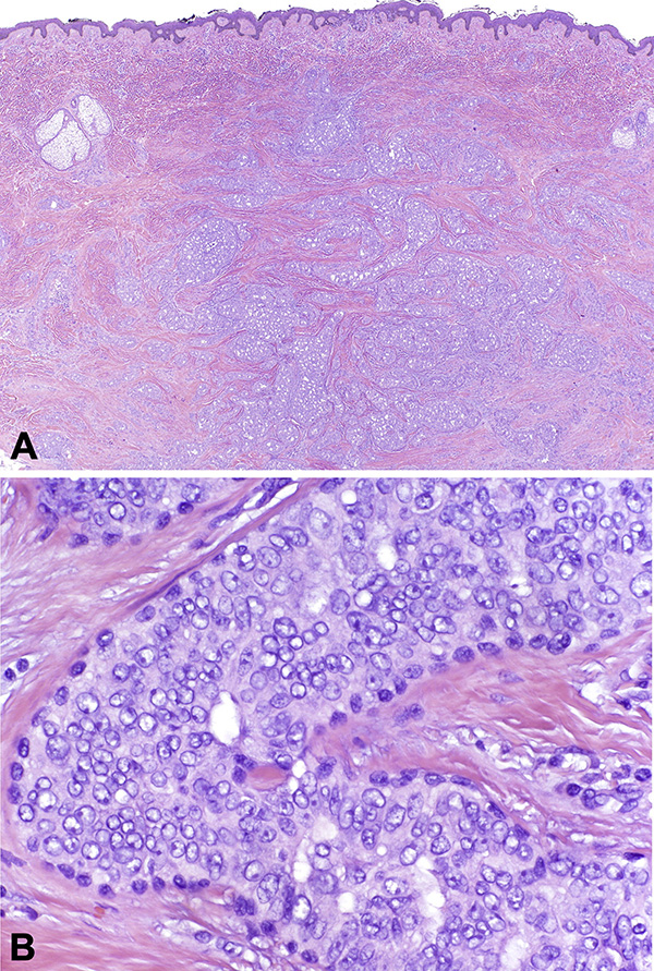 Histological images for DWII of squamoid eccrine ductal carcinoma