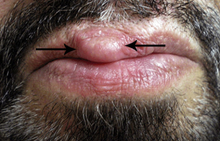 A lump on a musician's upper lip is a callus called trumpeter's wart