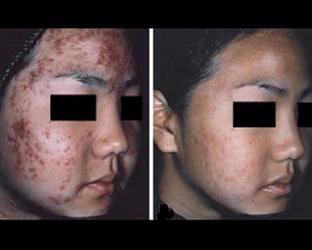 Antes e depois do tratamento da acne