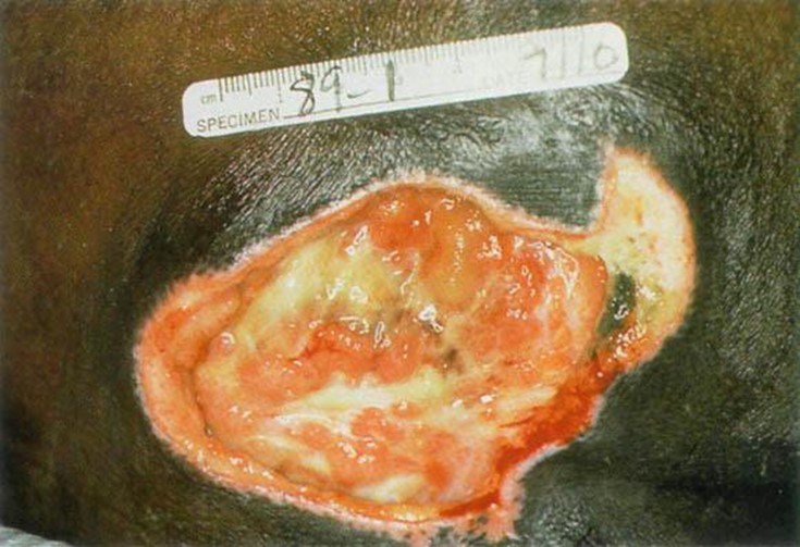 Image for DWII on pressure ulcers