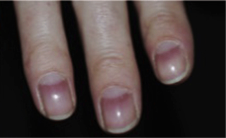 alopecia symptoms on fingernails